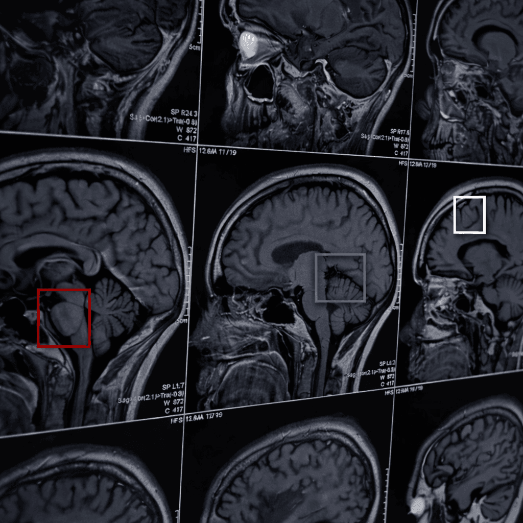 Brain Tumor Detection